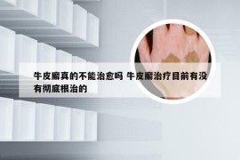 牛皮廨真的不能治愈吗 牛皮廨治疗目前有没有彻底根治的