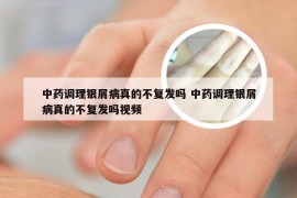 中药调理银屑病真的不复发吗 中药调理银屑病真的不复发吗视频