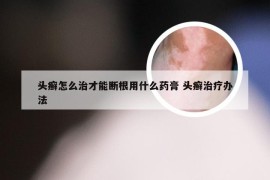 头癣怎么治才能断根用什么药膏 头癣治疗办法