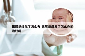 银屑病爆发了怎么办 银屑病爆发了怎么办能治好吗