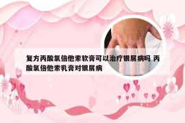 复方丙酸氯倍他索软膏可以治疗银屑病吗 丙酸氯倍他索乳膏对银屑病