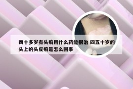 四十多岁有头癣用什么药能根治 四五十岁的头上的头皮癣是怎么回事