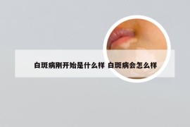 白斑病刚开始是什么样 白斑病会怎么样