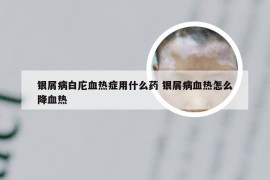 银屑病白庀血热症用什么药 银屑病血热怎么降血热