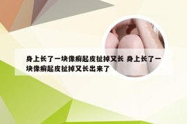 身上长了一块像癣起皮扯掉又长 身上长了一块像癣起皮扯掉又长出来了