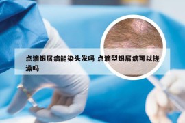 点滴银屑病能染头发吗 点滴型银屑病可以搓澡吗