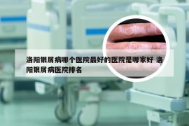 洛阳银屑病哪个医院最好的医院是哪家好 洛阳银屑病医院排名