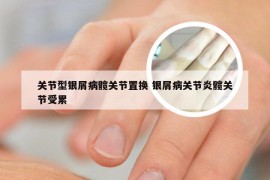 关节型银屑病髋关节置换 银屑病关节炎髋关节受累