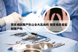 银屑病剖腹产伤口会大出血吗 银屑病患者能剖腹产吗