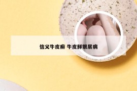 信义牛皮癣 牛皮鲜银屑病