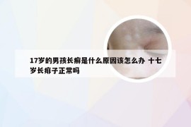 17岁的男孩长癣是什么原因该怎么办 十七岁长痱子正常吗