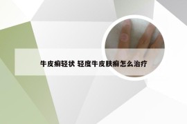 牛皮癣轻状 轻度牛皮肤癣怎么治疗