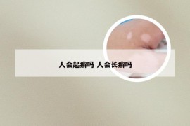 人会起癣吗 人会长癣吗