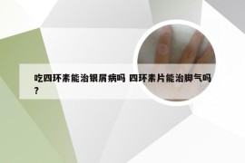 吃四环素能治银屑病吗 四环素片能治脚气吗?