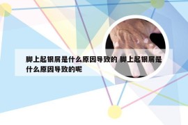 脚上起银屑是什么原因导致的 脚上起银屑是什么原因导致的呢