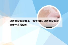 红皮病型银屑病会一直发烧吗 红皮病型银屑病会一直发烧吗