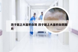 孩子腿上大面积白斑 孩子腿上大面积白斑图片