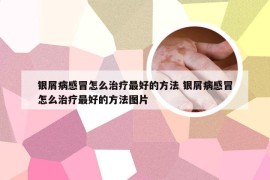 银屑病感冒怎么治疗最好的方法 银屑病感冒怎么治疗最好的方法图片