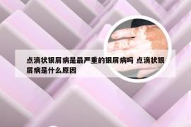 点滴状银屑病是最严重的银屑病吗 点滴状银屑病是什么原因