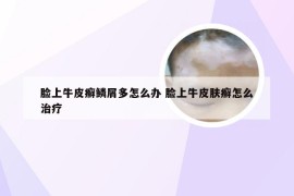 脸上牛皮癣鳞屑多怎么办 脸上牛皮肤癣怎么治疗