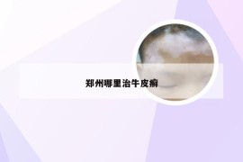 郑州哪里治牛皮癣