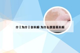 什麼为什麼会长癣 为什么很容易长癣