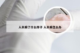 人长癣了什么样子 人长癣怎么办