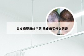 头皮癣要用啥子药 头皮癣买什么药膏