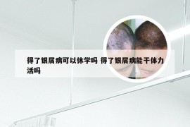 得了银屑病可以休学吗 得了银屑病能干体力活吗