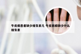 牛皮癣患者缺少维生素几 牛皮肤癣缺少什么维生素