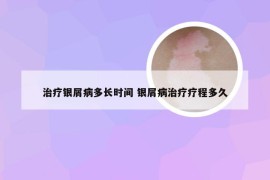 治疗银屑病多长时间 银屑病治疗疗程多久