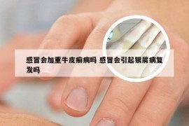 感冒会加重牛皮癣病吗 感冒会引起银屑病复发吗