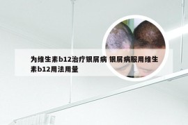 为维生素b12治疗银屑病 银屑病服用维生素b12用法用量