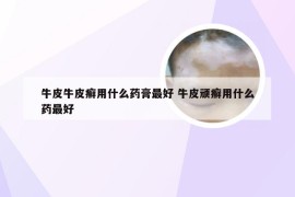 牛皮牛皮癣用什么药膏最好 牛皮顽癣用什么药最好