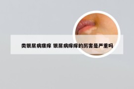 类银屑病瘙痒 银屑病痒痒的厉害是严重吗