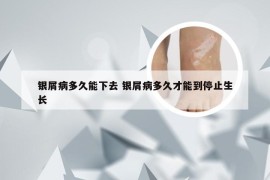 银屑病多久能下去 银屑病多久才能到停止生长