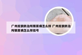 广州皮肤防治所银屑病怎么样 广州皮肤防治所银屑病怎么样挂号