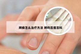 顾癣怎么治疗方法 顾昀百度百科