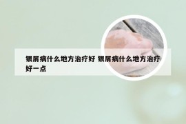 银屑病什么地方治疗好 银屑病什么地方治疗好一点