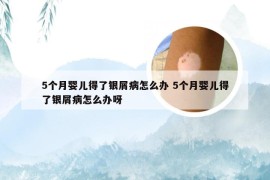 5个月婴儿得了银屑病怎么办 5个月婴儿得了银屑病怎么办呀