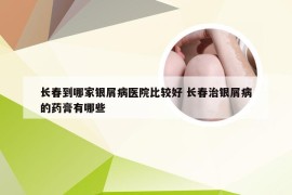 长春到哪家银屑病医院比较好 长春治银屑病的药膏有哪些