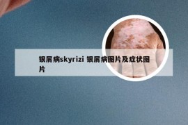 银屑病skyrizi 银屑病图片及症状图片