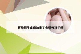 怀孕后牛皮癣加重了会遗传孩子吗