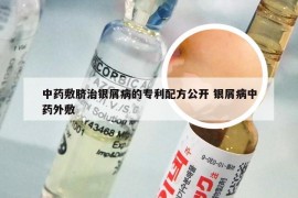 中药敷脐治银屑病的专利配方公开 银屑病中药外敷