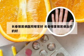 长春银屑病医院哪家好 长春哪里银屑病治疗的好