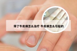 得了牛皮病怎么治疗 牛皮病怎么引起的