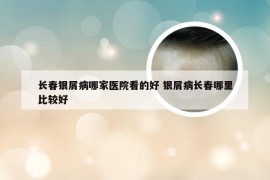 长春银屑病哪家医院看的好 银屑病长春哪里比较好