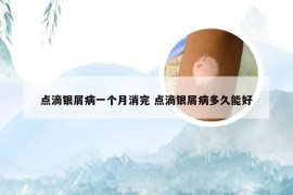 点滴银屑病一个月消完 点滴银屑病多久能好