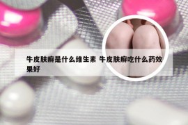 牛皮肤癣是什么维生素 牛皮肤癣吃什么药效果好