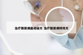 治疗银屑病最绝秘方 治疗银屑病特效方